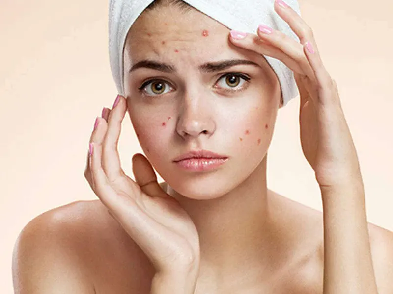 Busting the Myth: Acne Doesn't Just Affect Teenagers