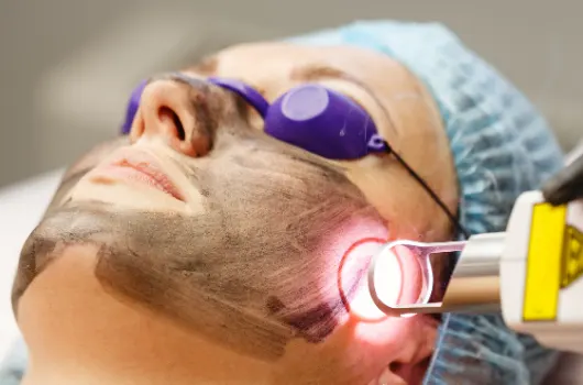 Laser Skin Lightening: Unveiling the Secret to Glowing, Fair Skin
