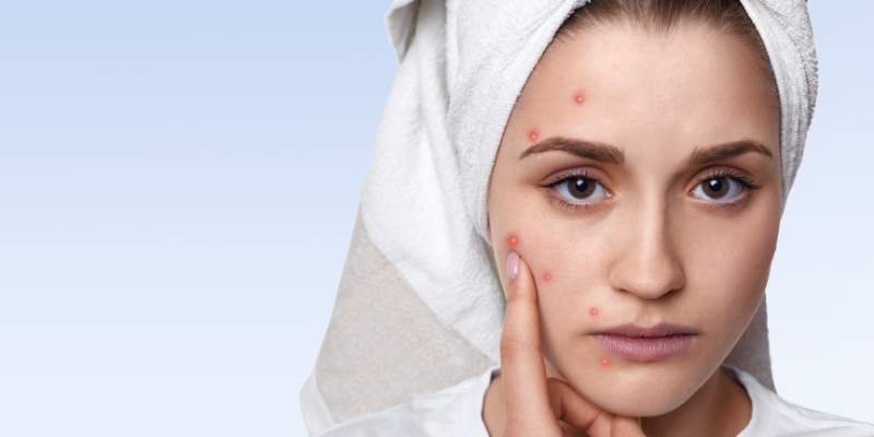 Stop Popping Pimples: Your Skin Deserves Better!