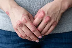 Title: Understanding Psoriasis: Causes, Symptoms, and Treatment Options